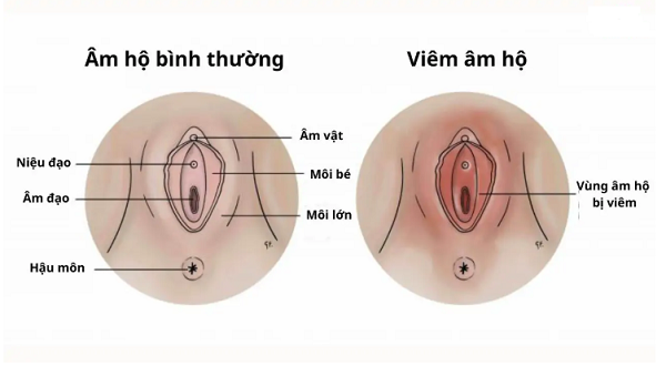Những lầm tưởng tai hại về viêm âm hộ mà chị em cần làm rõ!